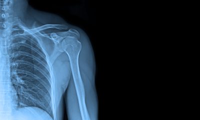 xray of shoulder